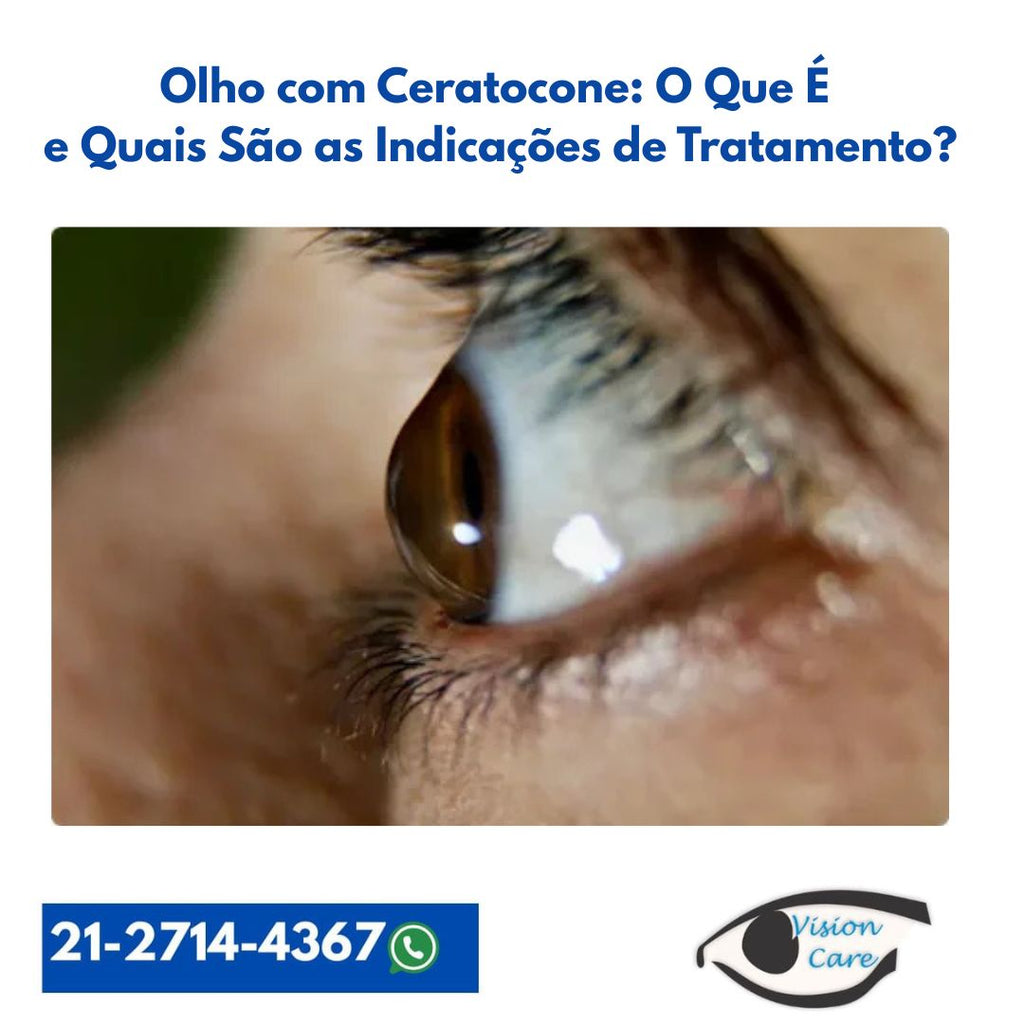 Olho com Ceratocone: O Que É e Quais São as Indicações de Tratamento?