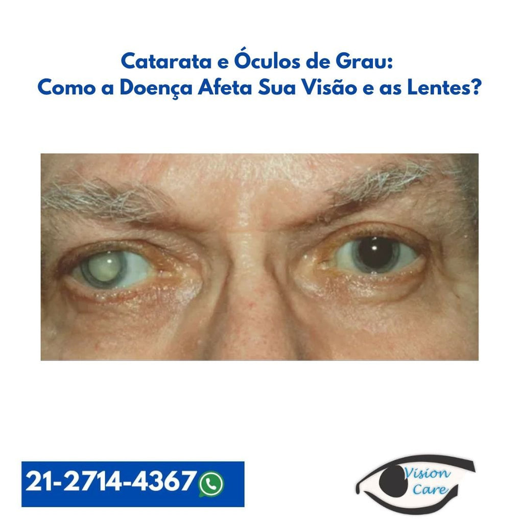 Catarata e Óculos de Grau: Como a Doença Afeta Sua Visão e as Lentes?