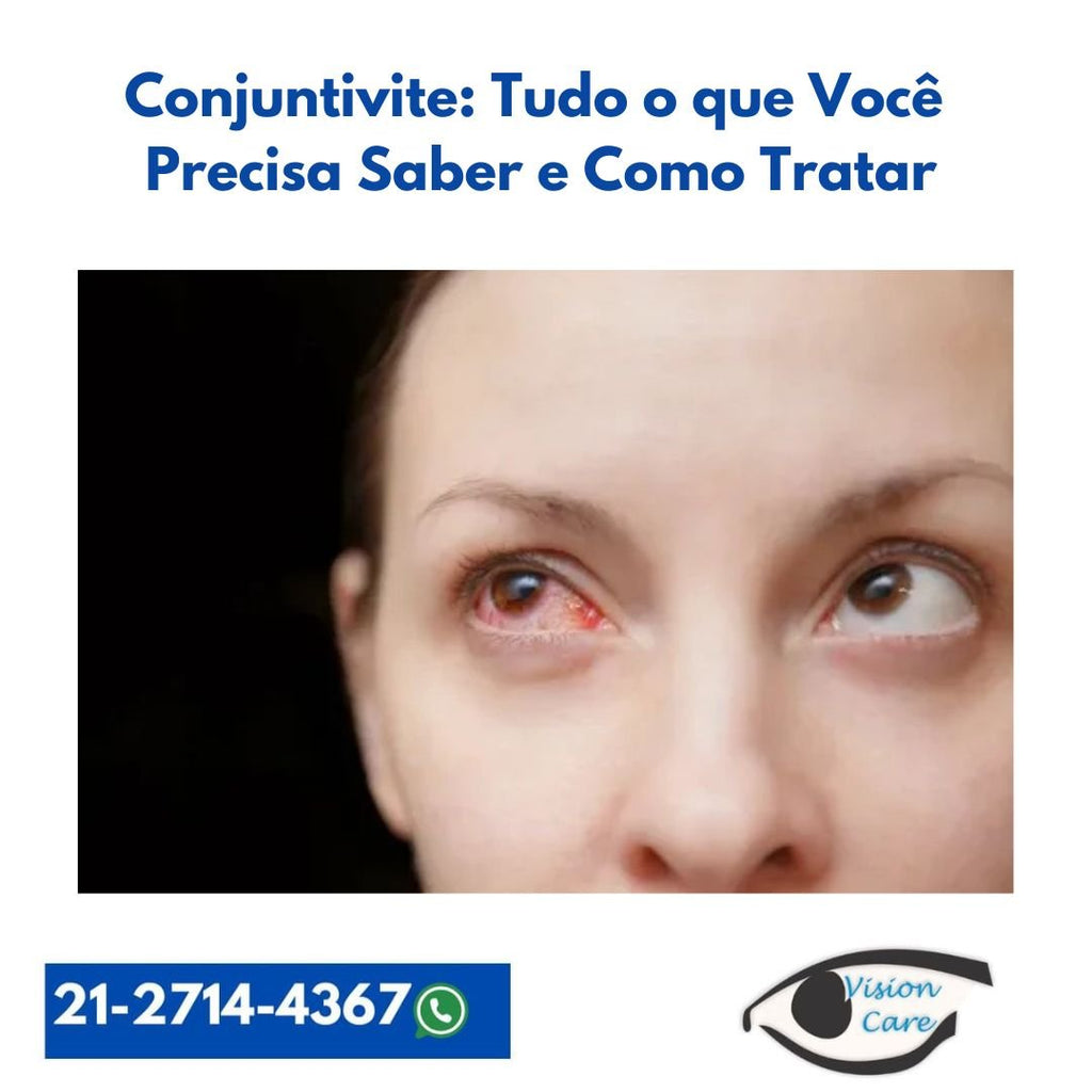 Conjuntivite: Tudo o que Você Precisa Saber e Como Tratar