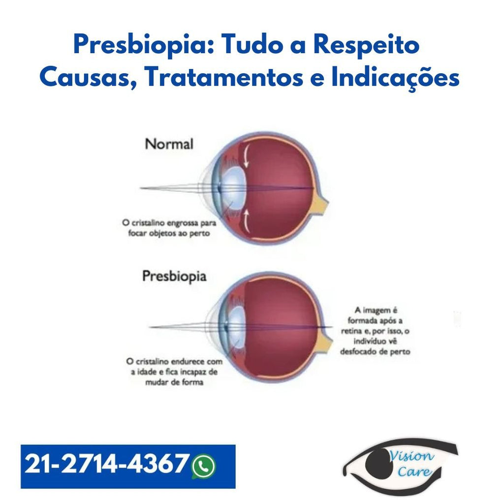 Presbiopia: Tudo a Respeito, Causas, Tratamentos e Indicações